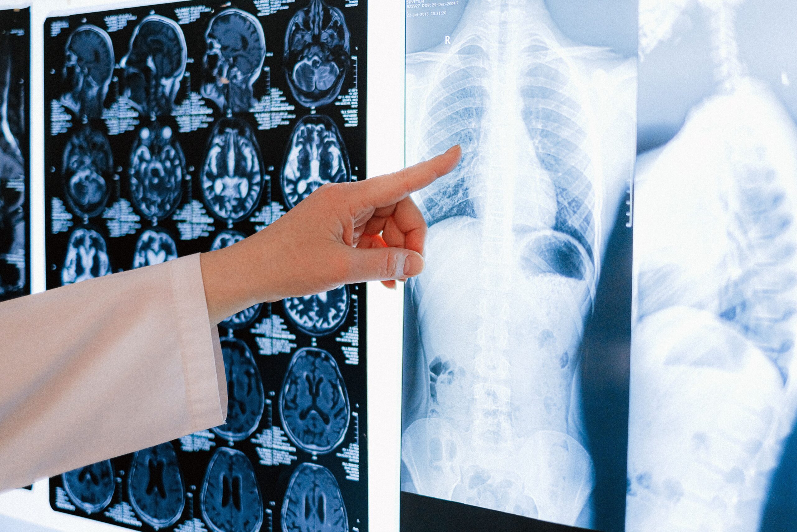 Médico examinando una radiografía de tórax y comparándola con imágenes de resonancia magnética en un negatoscopio