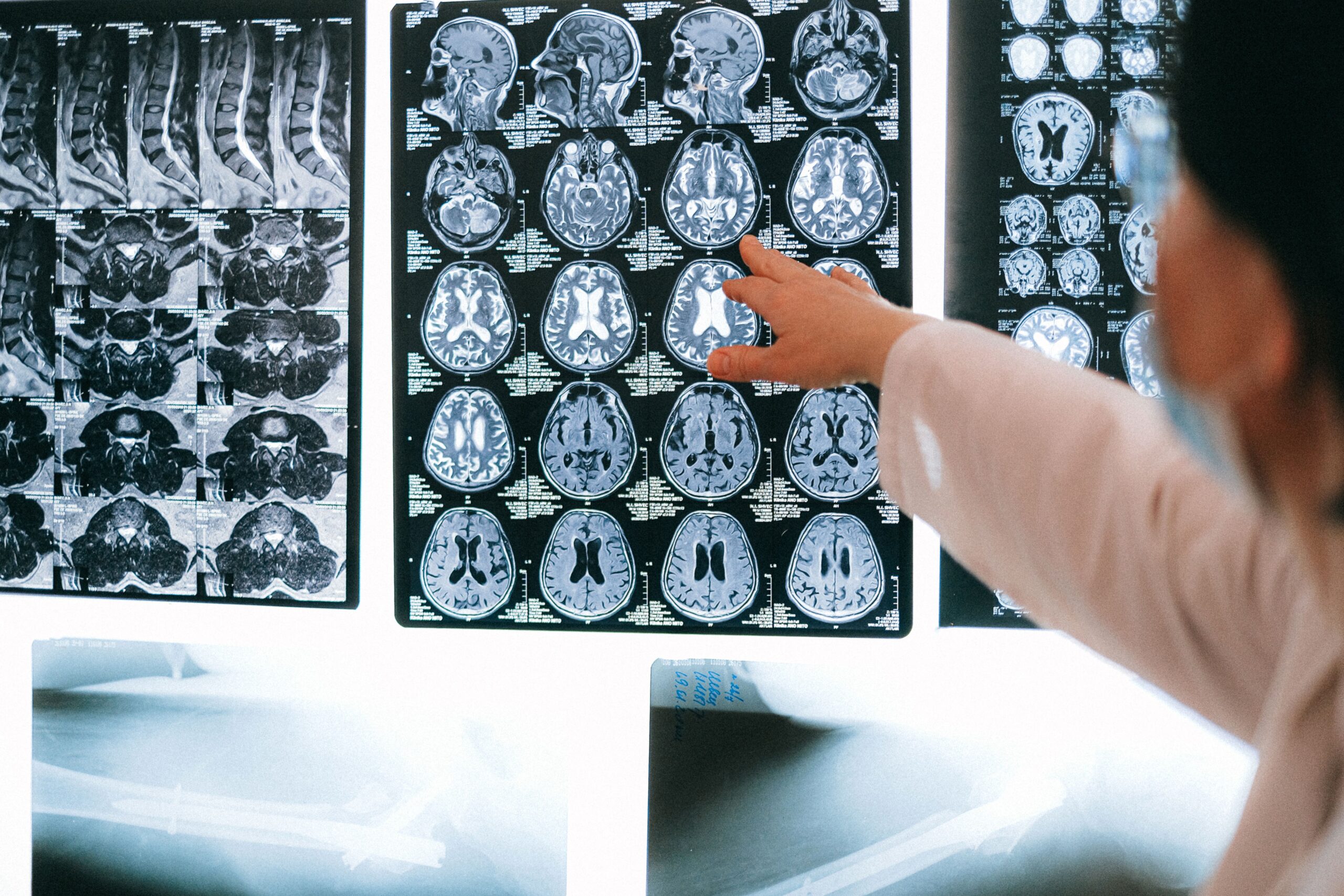 Primer plano de un especialista señalando hallazgos específicos en una resonancia magnética cerebral